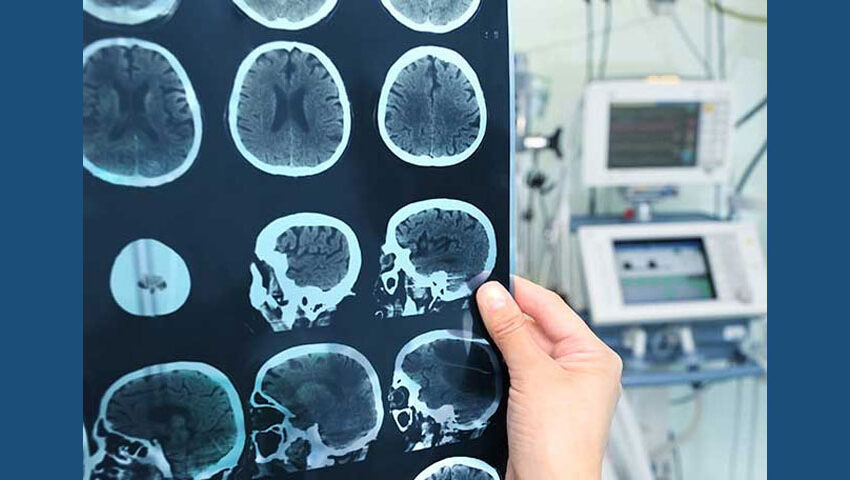  Investigación Podría Bajar Costo Del Tratamiento Para Pacientes Que Sufrieron Un Ataque Cerebro Vascular 